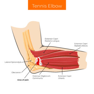 Tennis Elbow