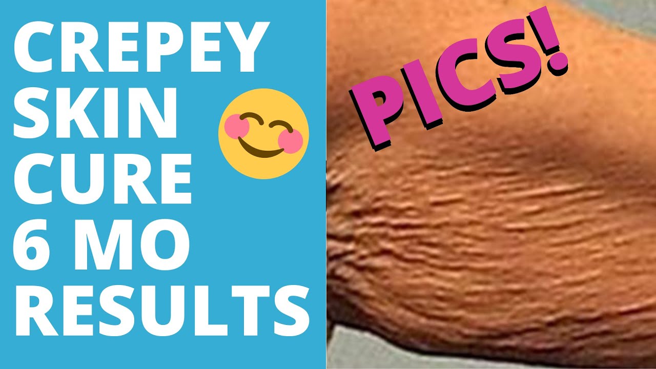 Video: HOW TO FIX CREPEY SKIN NATURALLY